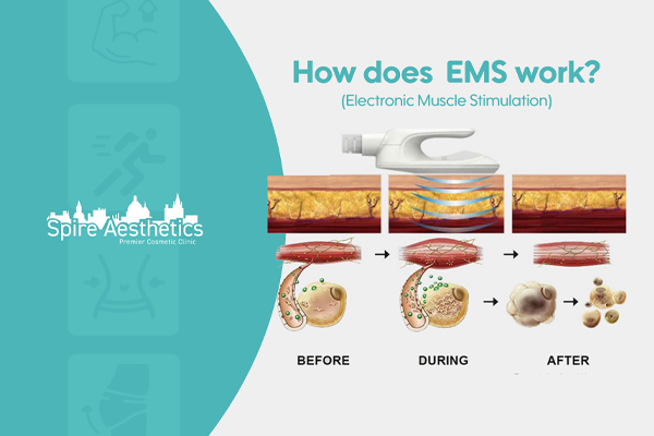 EMS treatment for post pregnancy weight loss treatment Hertford