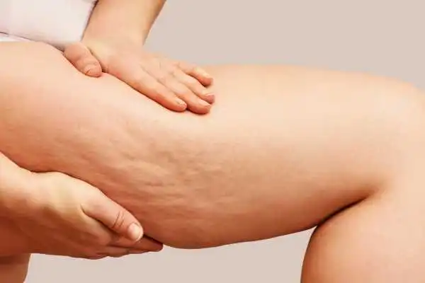 Image of woman showing leg with cellulite Hertford