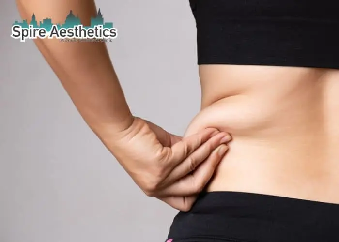 Image of woman pinching fat on their hips Hertford. Fat Freezing treatment