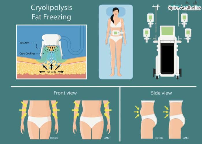 Image of diet and fat freezing combined for best results for Spire Aesthetics Hertford
