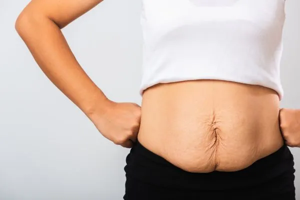 Image of a woman's stomach after weight loss with sagging skin following a gastric band Hertford