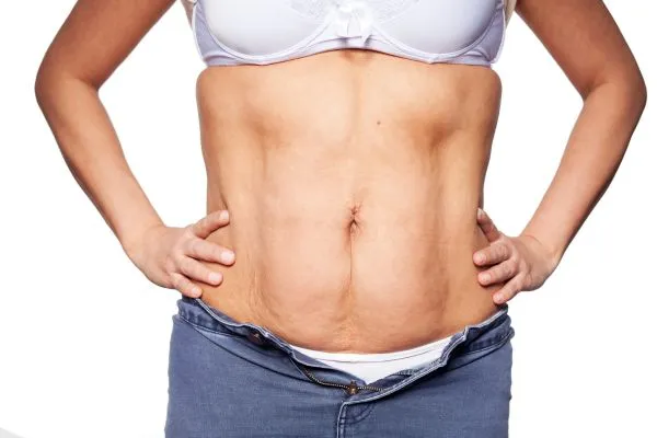 sagging skin on woman's stomach after weight loss injections Hertford
