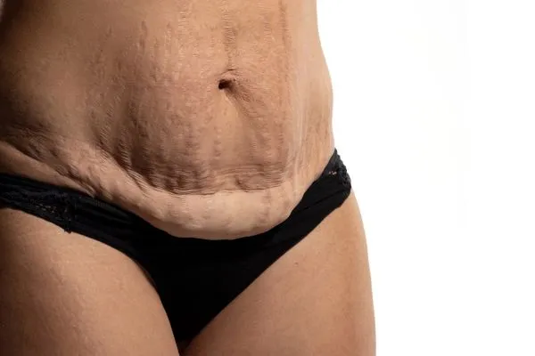 Image of womans stomach after weight loss injections Hertford showing saggy skin