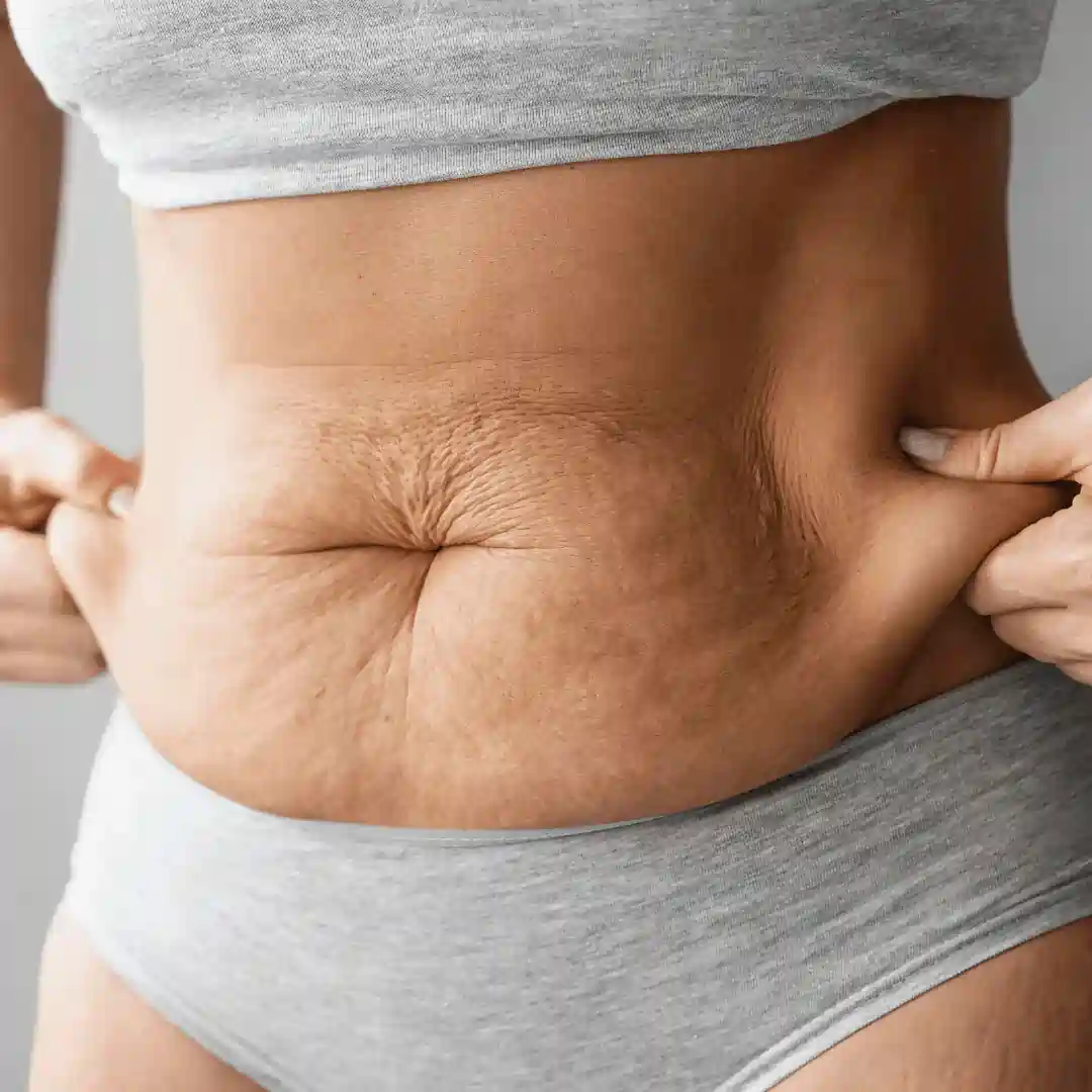 Is It Normal to Have Loose Skin After Pregnancy Hertford?