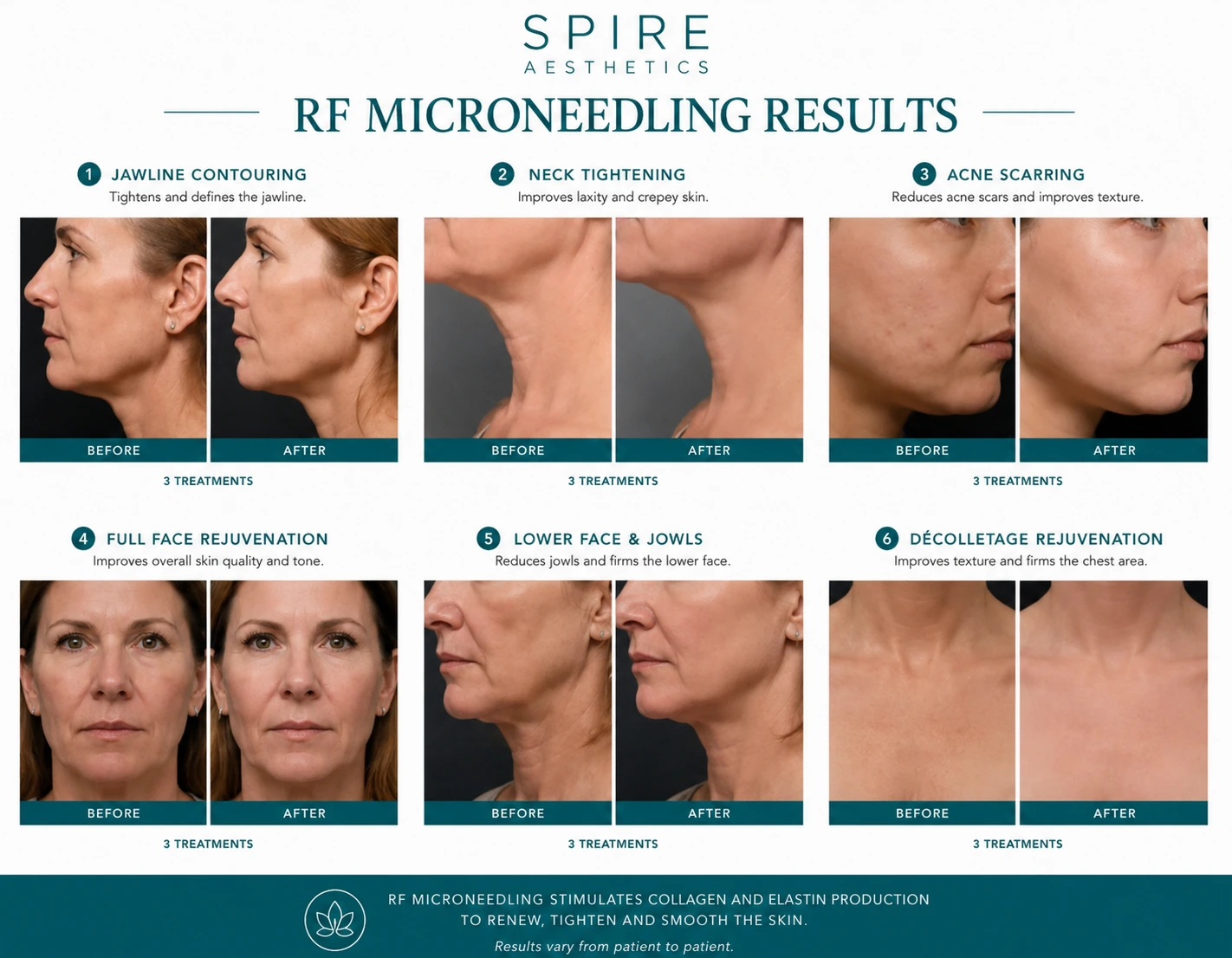 RF Microneedling Skin tightening Hertford results