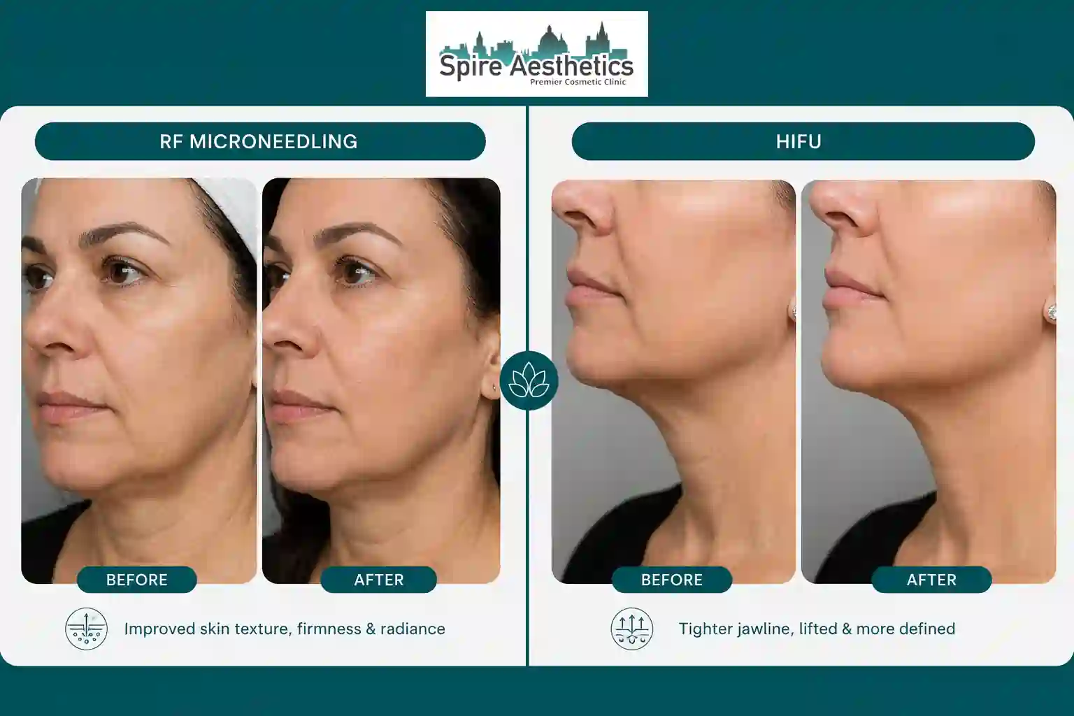 Can RF Microneedling and HIFU Be Combined Hertford?