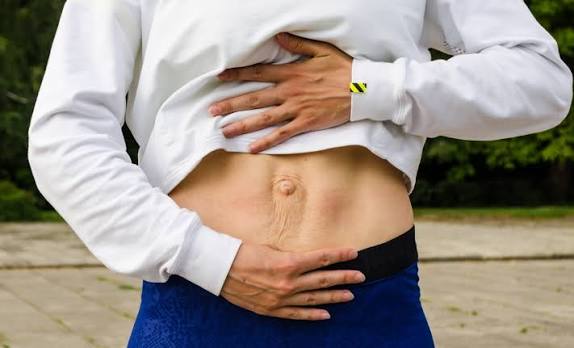 When Could Diastasis Recti Be the Missing Piece of the Puzzle Hertford?