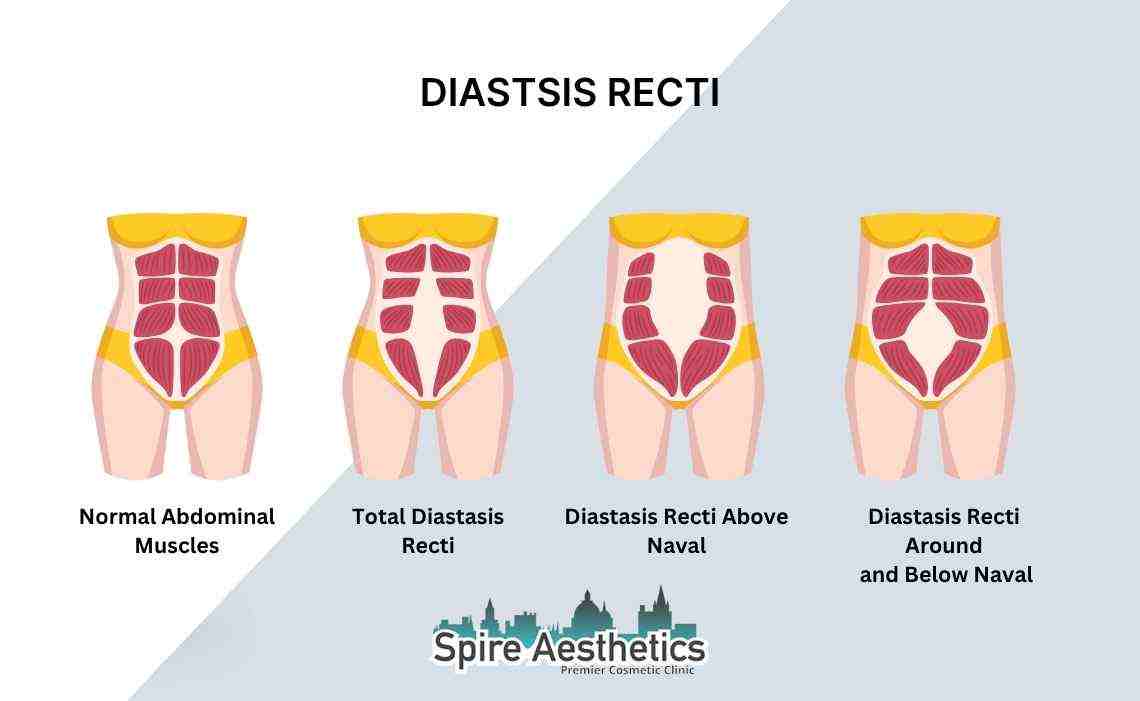 Is Non-Surgical Diastasis Recti Treatment Right for You? Common Concerns Answered Hertford